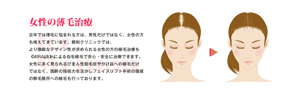 女性の薄毛治療